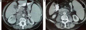 Tomografía computada de abdomen: se advierte un aumento del tamaño esplénico. Tiene un aspecto homogéneo con adenomegalias retroperitoneales. Nótese el desplazamiento del riñón izquierdo.