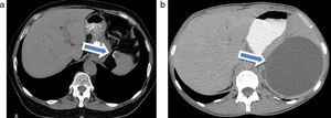 (a) Tomografía computada de abdomen sin contraste en corte axial: pequeño quiste con calcificación parietal a nivel del polo superior esplénico (flecha). (b) Imagen hipodensa a nivel esplénico, compatible con quiste epitelial gigante (flecha).