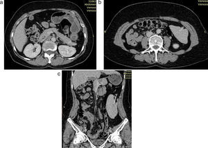 (a) Tomografía computada de abdomen: ausencia de bazo en celda esplénica. (b y c) Tomografía computada de abdomen: bazo descendido en el flanco izquierdo, con elongación y ubicación invertida de su pedículo vascular, que denota rotación libre.