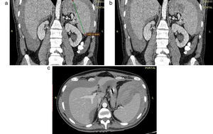(a-c) Paciente con mononucleosis y esplenomegalia. Se observa un gran hematoma periesplénico y un área hipodensa intraparenquimatosa en el polo superior, sugiriendo rotura espontánea. También se evidencia líquido hemático de menor densidad a nivel perihepático.