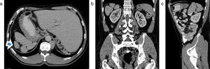 (a-c) Tomografía computada multidetector, corte axial, coronal y sagital, en un paciente con situs ambiguo. Se observan múltiples bazos sobre el hipocondrio derecho (flecha en a).