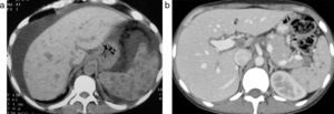 (a) Tomografía computada de abdomen en paciente HIV con infección oportunista por cándida: se observan múltiples imágenes hipodensas en el bazo y el hígado, y ascitis. (b) Tomografía computada de abdomen con contraste en paciente HIV con infección por tuberculosis: se evidencian múltiples nódulos hipodensos esplénicos y adenomegalias en el hilio hepático.