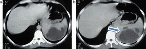 (a y b) Tomografía computada de abdomen con una imagen hipodensa a nivel esplénico. La lesión es multiloculada y corresponde a un absceso piógeno esplénico (flecha en b).