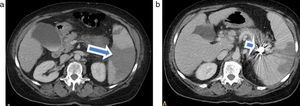 (a) Tomografía computada de abdomen con contraste muestra múltiples imágenes hipodensas, algunas de aspecto triangular, compatibles con infartos esplénicos (flecha). (b) Se observa un artefacto metálico en proyección del hilio esplénico (aneurisma esplénico tratado con coils) (flecha).