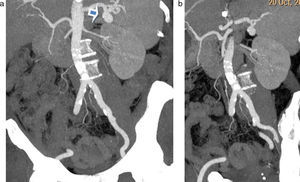 (a y b) Reconstrucciones en proyecciones de máxima intensidad de angiografía por tomografía computada de aorta que evidencia una imagen sacular en el hilio esplénico, compatible con aneurisma de la arteria esplénica (flecha en a).