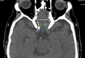Tomografía computada multicorte de encéfalo, plano axial, donde se observa una placa cálcica focal en el segmento supraclinoideo de la carótida derecha (flecha).