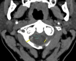 Tomografía computada multicorte de encéfalo, plano axial a nivel del foramen magno, donde se observan placas cálcicas en los segmentos V4 de ambas arterias vertebrales (flechas).