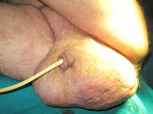 Masa escrotal de gran tamaño con supuración extensa por poros cutáneos en el área genital.