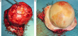 (a y b) Pieza quirúrgica del divertículo uretral con litiasis.