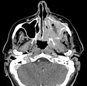 Tomografía computada con algoritmo de partes blandas y contraste intravenoso: se observa una lesión centrada en el seno maxilar izquierdo que produce destrucción ósea y extensión hacia el espacio masticatorio y la nasofaringe.