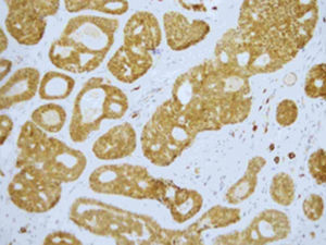 Anatomía patológica de la lesión, tinción inmunohistoquímica CD-117 con aumento 20x: se observa expresión de c-Kit en las células ductales. Estas presentan proliferación celular con patrón cribiforme.