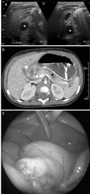 Niña de 9 meses de edad con un quiste de duplicación con ectopia pancreática. (a) La ecografía, con corte transversal y longitudinal del epigastrio, muestra una imagen redondeada y anecoica, de aproximadamente 1,3 x 0,8cm, en la región antropilórica (asteriscos). (b) El corte axial de la TC evidencia una imagen quística en íntimo contacto con la pared posterior del antro pilórico (flechas). (c) Imagen endoscópica.