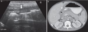 Niño de 9 años con antecedentes de inmunodeficiencia primaria y diagnóstico de gastritis crónica. (a) La ecografía abdominal muestra un engrosamiento de la pared gástrica en la región antropilórica (flecha), mientras que (b) la TC, en corte axial del hemiabdomen superior, revela los mismos hallazgos que la ecografía (flechas).