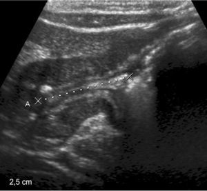 Ecografía en corte longitudinal de un paciente de 6 años con gastritis crónica muestra engrosamiento de la pared antropilórica.