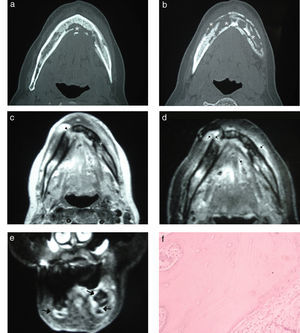 Osteonecrosis por bifosfonatos. (a y b) Tomografía computada del maxilar inferior, corte axial: se aprecia la necrosis afectando el hueso medular y ambas corticales (asteriscos). (c) Resonancia magnética en ponderación T1 del maxilar inferior, corte axial: se observa un cambio de señal del hueso medular por la osteonecrosis que se extiende hacia las corticales, con afectación de los tejidos blandos adyacentes (cabezas de flechas). (d) Resonancia magnética en ponderación T2 con supresión grasa, corte axial: se advierte, además del compromiso óseo, la afectación de los tejidos blandos con señal hiperintensa (flechas). (e) Resonancia magnética en ponderación T2 con supresión grasa, corte coronal: se evidencia un aumento de la señal en los tejidos blandos y el maxilar inferior (flechas). (f) Anatomía patológica de la lesión, tinción con hematoxilina-eosina con aumento x 500: se observan fragmentos óseos necróticos y tejido de granulación con fibrosis.