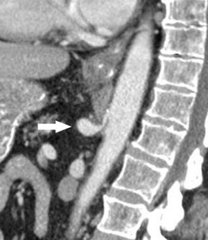 Reconstrucción en plano sagital (TCMD) en inspiración forzada. Impronta del ligamento arcuato mediano sobre el origen del tronco celíaco, estenosando su luz y dándole la típica morfología en “gancho”, con dilatación posestenótica asociada (flecha): síndrome del ligamento arcuato mediano. (Tomado de Soliva Martínez D, Fernández Iglesias P, Belda González I, Martínez Yunta JA, Hernández Muñoz L, Blanco López ME. Hallazgos poco conocidos en el síndrome del ligamento arcuato mediano. 10.1594/seram2014/S-0407).