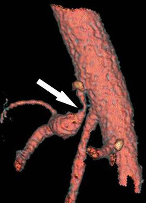 Reconstrucción vascular (TCMD) en inspiración forzada del mismo paciente. Se visualiza el segmento proximal del tronco celíaco con la típica morfología en forma de “gancho” y estenosis de su luz en el origen por impronta de ligamento arcuato mediano (flecha), y dilatación posestenótica: síndrome del ligamento arcuato mediano. (Tomado de Soliva Martínez D, Fernández Iglesias P, Belda González I, Martínez Yunta JA, Hernández Muñoz L, Blanco López ME. Hallazgos poco conocidos en el síndrome del ligamento arcuato mediano. 10.1594/seram2014/S-0407).