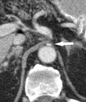 Signo del moño y la mantilla en el síndrome del ligamento arcuato mediano del diafragma: corte tomográfico convencional en plano axial del mismo paciente donde se aprecia el tronco celíaco comprimido y deformado entre la aorta abdominal ubicada dorsalmente y el ligamento arcuato mediano localizado ventralmente (flecha). Este último rodea prácticamente a los otros. (Tomado de Soliva Martínez D, Fernández Iglesias P, Belda González I, Martínez Yunta JA, Hernández Muñoz L, Blanco López ME. Hallazgos poco conocidos en el síndrome del ligamento arcuato mediano. 10.1594/seram2014/S-0407).