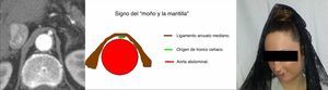 Ilustración del signo del moño y la mantilla en el síndrome del ligamento arcuato mediano del diafragma. De izquierda a derecha: TC convencional en el plano axial (otro paciente), representación esquemática del signo y modelo representativo. (Tomado de Soliva Martínez D, Fernández Iglesias P, Belda González I, Martínez Yunta JA, Hernández Muñoz L, Blanco López ME. Hallazgos poco conocidos en el síndrome del ligamento arcuato mediano. 10.1594/seram2014/S-0407).