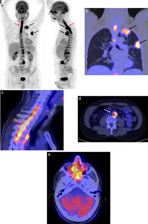 (a) Imagen volumétrica de la tomografía con emisión de positrones, en proyecciones anteroposterior y lateral: se aprecian captaciones patológicas de 18F-FDG en las masas pulmonares (flechas negras) sobre el rodete hiperdenso de la aorta (flecha blanca), en la médula espinal entre C5-D5 (flecha roja) y en los senos paranasales (asterisco). (b) 18F-FDG-PET/TC de tórax, corte coronal de imágenes de fusión: hipermetabolismo en las masas apical (SUV 7,82) y subpleural del lóbulo superior (SUV 8,35) del pulmón izquierdo, compatibles en una primera instancia con un proceso oncológico (flechas negras). (c) 18F-FDG-PET/TC de la columna cérvico-dorsal, corte sagital de imágenes de fusión: hipermetabolismo en la médula espinal (SUV 7,7) entre C5-D5 que, en el contexto oncológico, sugería con más probabilidades una infiltración metastásica (flecha roja). (d) 18F-FDG-PET/TC de abdomen, corte axial de imágenes de fusión: hipermetabolismo sobre el rodete periaórtico (SUV 6,5), sospechoso de infiltración metastásica (flecha blanca). (e) 18F-FDG-PET/TC del cráneo, corte axial de imágenes de fusión: captación en los senos paranasales (SUV 9,3), de distribución simétrica y homogénea, sugerente de un proceso inflamatorio-infeccioso (asterisco).