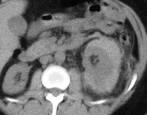 Se observa un hematoma perirrenal subcapsular espontáneo en la TC sin contraste de una paciente con enfermedad de Wegener que presenta dolor e hipertensión arterial brusca (riñón de Page).