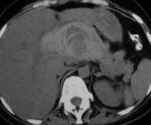 Pancreatitis necrohemorrágica en un paciente masculino de 35 años. La TC sin contraste demuestra un gran hematoma en la topografía de la cabeza e istmo pancreático.