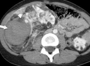 Rotura espontánea de un angiomiolipoma renal en una paciente de 40 años con esclerosis tuberosa. La TC con contraste muestra angiomiolipomas bilaterales con el signo del coágulo centinela (flecha) y un foco de sangrado activo (cabeza flecha) en el riñón derecho.