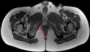 Secuencia axial en ponderación T1: se evidencia un engrosamiento de la sincondrosis isquipubiana derecha, sin formación de puente fibroso en este caso (flecha). También se observan huellas quirúrgicas a nivel inguinal izquierdo.