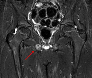 Secuencia coronal STIR: se observa un engrosamiento con edema óseo a nivel de la sincondrosis isquiopubiana derecha, adyacente al músculo obturador externo (flecha).
