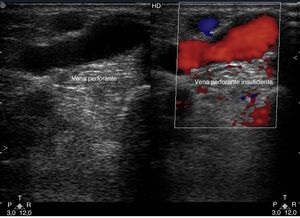 Vena perforante mayor de 3mm con reflujo en el Doppler color.
