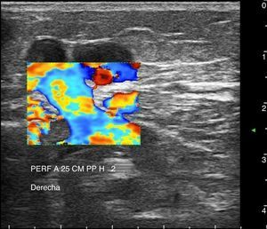 Imagen de la vena perforante insuficiente con un diámetro mayor de 3mm que muestra aliasing, mediante la maniobra de aguas arriba, en el Doppler color.
