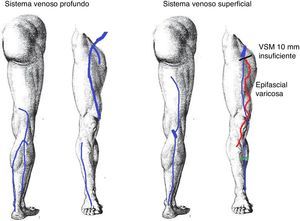 Anotaciones del informe: VSM dilatada (10mm) desde la USF con presencia de epifascial varicosa en el muslo y la pierna, y reentrada en perforante insuficiente en hora 3 a 20cm de la planta del pie.