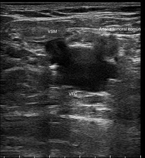 Signo de Mickey Mouse: imagen transversal donde se identifica la vena femoral común (VFC), la arteria femoral común y la vena safena magna (VSM).
