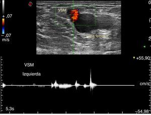 Doppler espectral con corte transversal evidencia una VSM suficiente ante las maniobras de Valsalva.