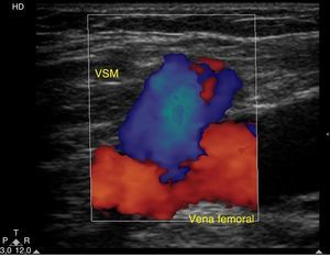Corte longitudinal donde se evidencia un flujo reverso ante las maniobras de Valsalva en la unión safena-femoral (viraje de color rojo, en descanso a color azul, en Valsalva).
