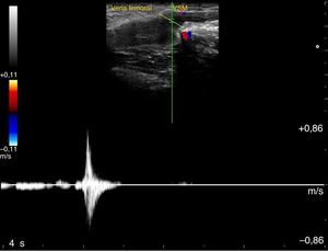 Imagen que demuestra el cierre valvular correcto sin reflujo en la VSM con el Doppler color y espectral.