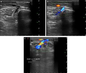 (a) Vena perforante yuxtatibial, (b) vena perforante yuxtatibial con presencia de flujo sin maniobras de provocación y (c) vena perforante yuxtatibial insuficiente con aliasing (flujo color multidireccional), tras la maniobra de aguas arriba (compresión de la masa muscular a nivel de la pantorrilla).