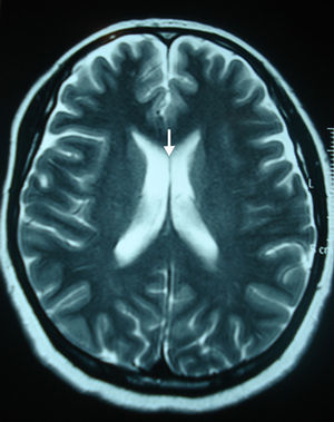 Resonancia magnética de cerebro, corte axial en ponderación T2: se señala el septum pellucidum (lucidum) normal (flecha).
