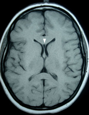 Resonancia magnética de cerebro, corte axial en ponderación T1: se aprecia la presencia de una cavidad triangular entre las prolongaciones frontales de los ventrículos laterales, conocida como cavum del septum pellucidum (cabeza de flecha).