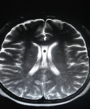 Resonancia magnética de cerebro, corte axial, en ponderación T2: se observa una cavidad que contiene líquido cefalorraquídeo y se interpone entre los ventrículos laterales (asterisco). El hallazgo es compatible con cavum septum pellucidum asociado a cavum vergae.