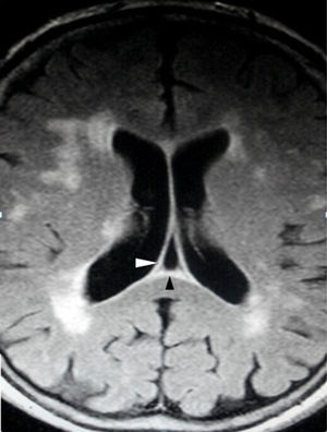 Resonancia magnética de cerebro, corte axial FLAIR: se manifiesta una cavidad triangular cefálica al trígono, entre los ventrículos laterales, denominada cavum del velo interpósito (cabezas de flecha).