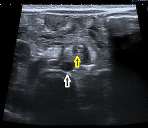 Corte transversal del abdomen superior de un neonato masculino de 4 días de vida, con vómitos biliosos y distensión abdominal. La flecha amarilla muestra la AMS envuelta por la VMS y la grasa mesentérica (vólvulo de intestino medio); mientras que la flecha blanca señala la aorta abdominal.