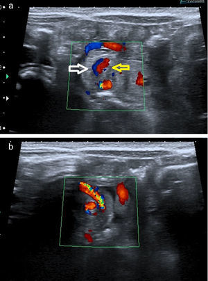 (a y b) Signo del remolino o whirlpool sign: paquete vascular mesentérico (VMS: flecha blanca; AMS: flecha amarilla) envolviéndose junto al mesenterio y a un asa del intestino delgado.