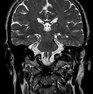 Imagen coronal de una resonancia magnética eco de espín, ponderada en T2, donde se visualiza claramente la cara de un cerdo.