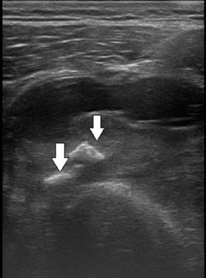 Ecografía del muslo en plano transversal. El control evolutivo a los 21 días evidencia un proceso cicatrizal calcificado ecogénico (flechas) circundado por la colección hemática.