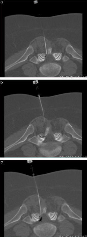 (a y b) El extremo de la aguja no atraviesa el ligamento amarillo y el aire puede identificarse por fuera del espacio epidural, observándose una artroneumografía facetaria L5/S1 izquierda. (c) La aguja avanza hasta traspasar el ligamento amarillo. El aire aquí se encuentra en el espacio epidural.