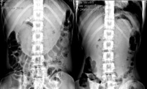 Las radiografías de abdomen de pie muestran una marcada distensión del estómago y una masa radiopaca moteada que ocupa y moldea la cámara gástrica, delimitada por aire en la mayor parte de su contorno.