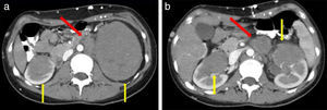 (a y b) Múltiples lesiones sólidas en ambos riñones, con escaso realce tras la administración de contraste endovenoso (flechas amarillas), y adenomegalias retroperitoneales (flechas rojas).