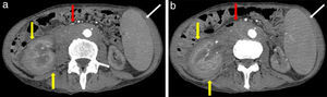 (a y b) Imágenes hipodensas que infiltran el espacio perirrenal sin alterar la morfología renal (flechas amarillas), adenomegalias retroperitoneales que rodean la aorta (flechas rojas), y esplenomegalia (flecha blanca).