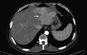 La TCMC de abdomen en fase arterial evidencia alteración de la perfusión hepática (flecha), reconociendo realce heterogéneo glandular (característica de colangitis esclerosante).
